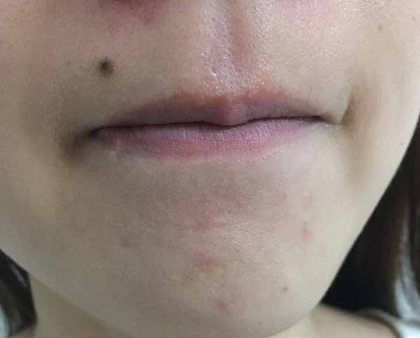 達爾膚杏仁酸溫和煥膚精華液怎么樣 達爾膚杏仁酸溫和煥膚精華液使用測評