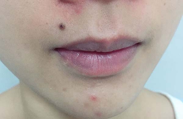 達爾膚杏仁酸溫和煥膚精華液怎么樣 達爾膚杏仁酸溫和煥膚精華液使用測評