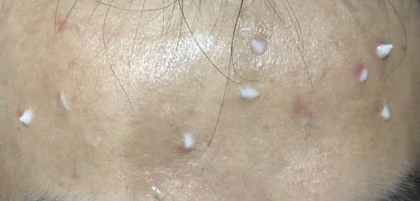 理膚泉青春痘調理精華乳怎么樣 理膚泉青春痘調理精華乳使用測評