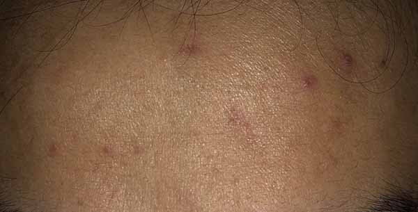 理膚泉青春痘調理精華乳怎么樣 理膚泉青春痘調理精華乳使用測評