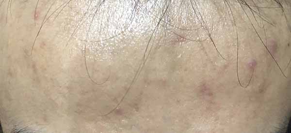 理膚泉青春痘調理精華乳怎么樣 理膚泉青春痘調理精華乳使用測評