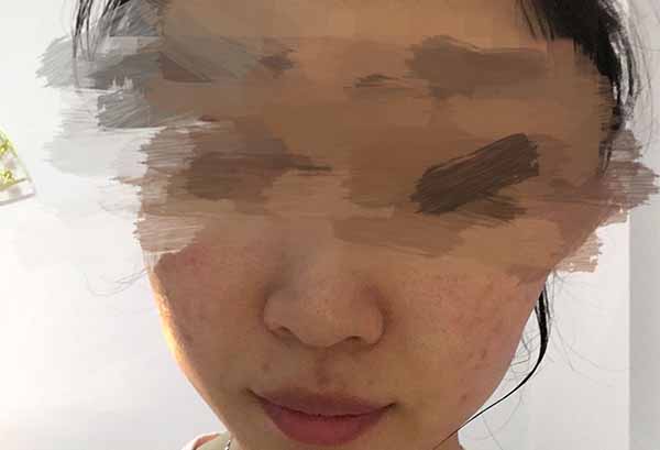 花印抗痘補濕凝露怎么樣 效果好嗎