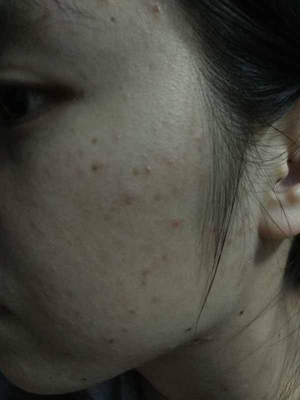 ISDIN 怡思丁祛痘凝膠的祛痘效果使用測評