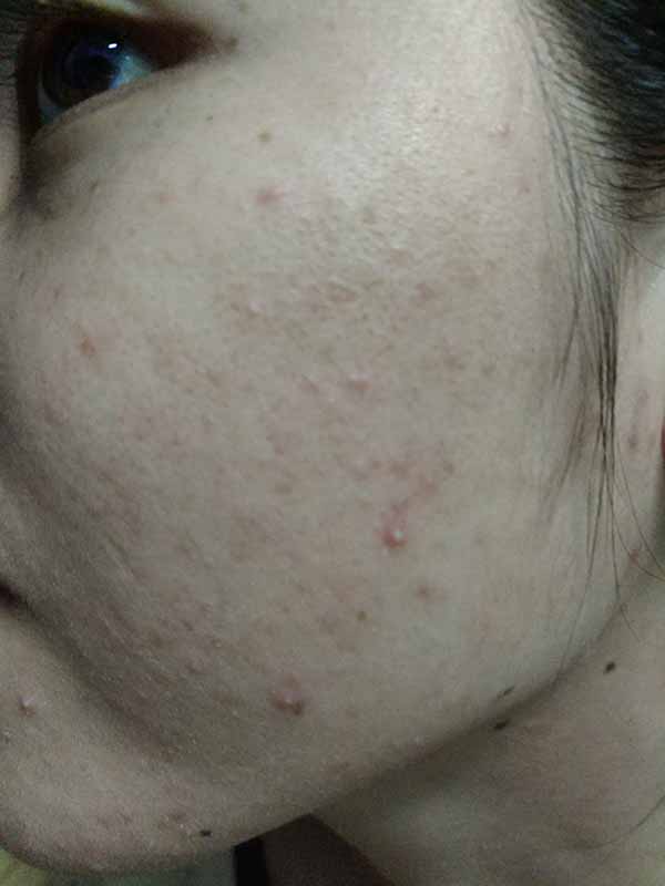 ISDIN 怡思丁祛痘凝膠的祛痘效果使用測評